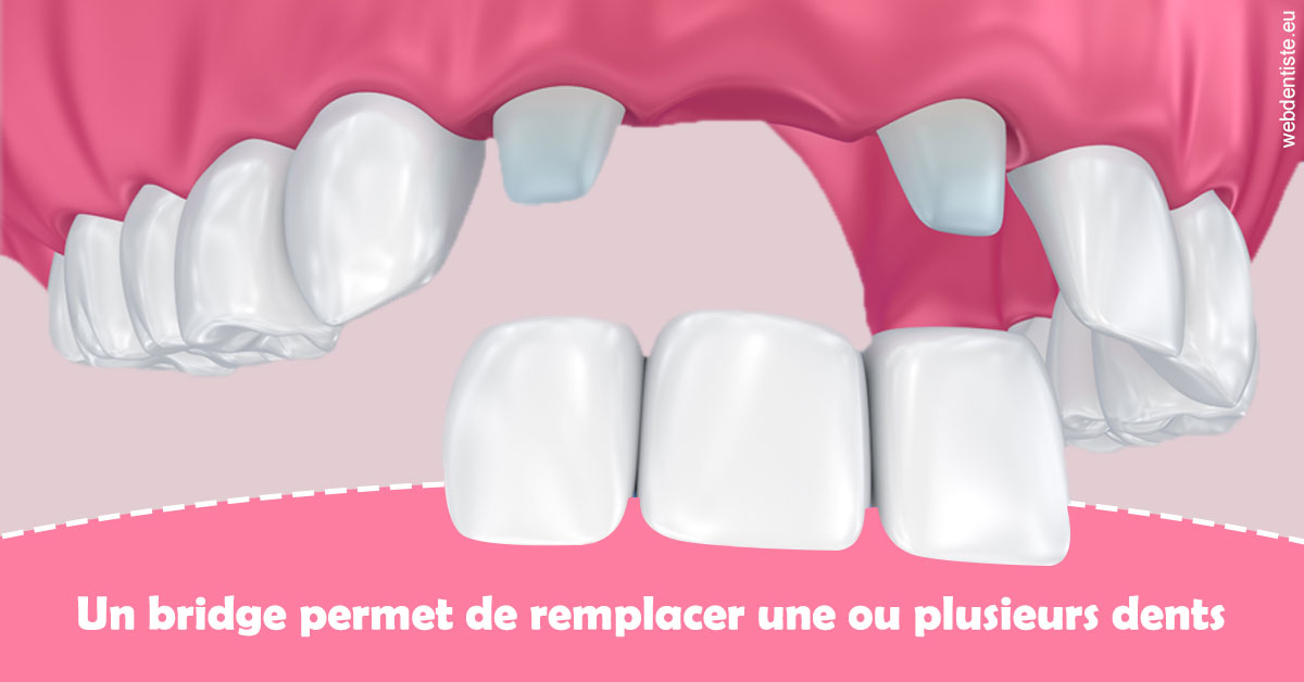 https://www.scm-adn-chirurgiens-dentistes.fr/Bridge remplacer dents 2