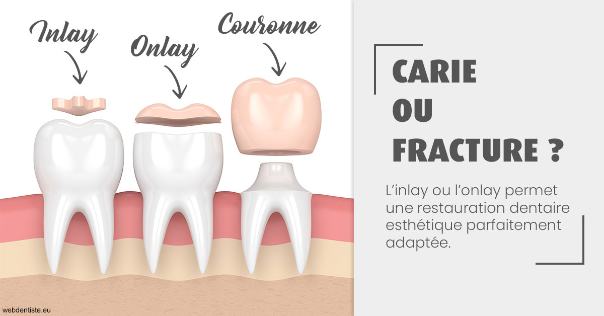 https://www.scm-adn-chirurgiens-dentistes.fr/T2 2023 - Carie ou fracture 1