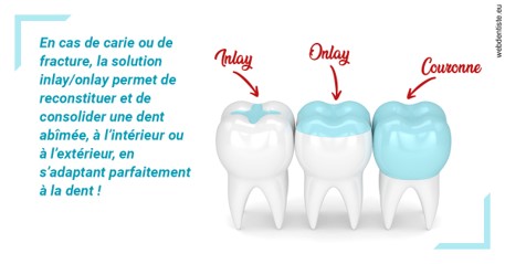 https://www.scm-adn-chirurgiens-dentistes.fr/L'INLAY ou l'ONLAY