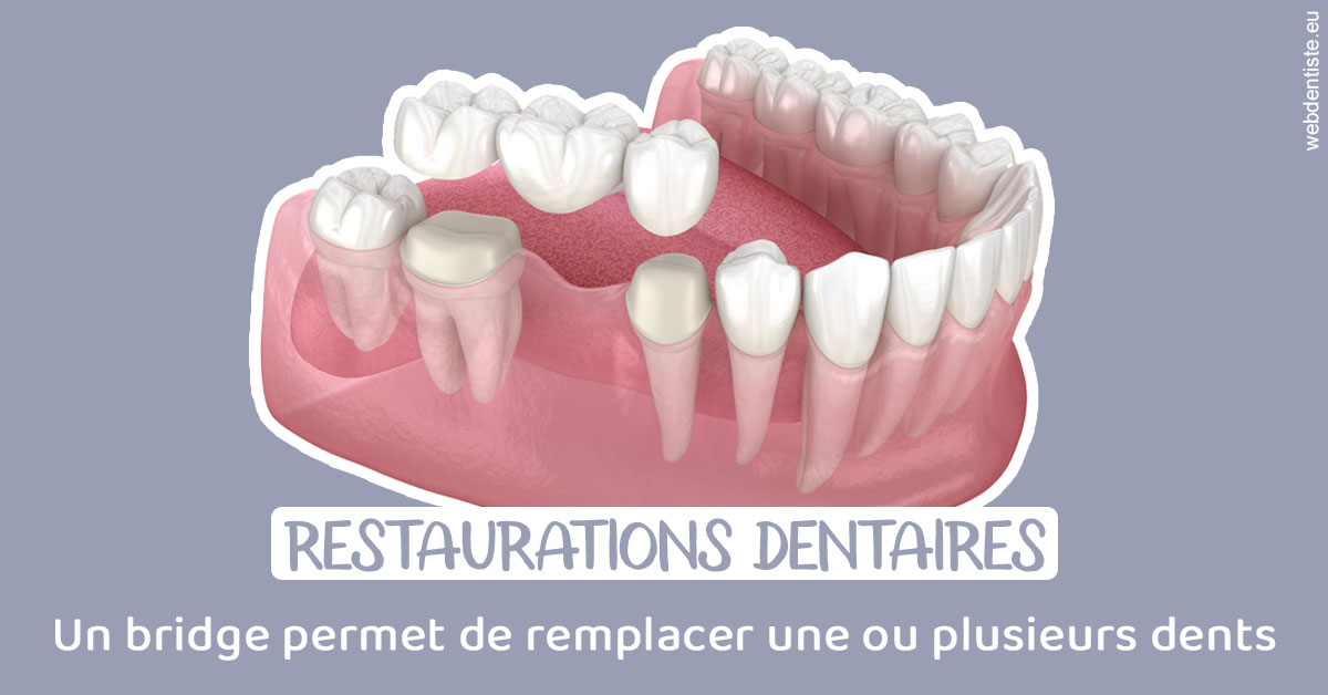 https://www.scm-adn-chirurgiens-dentistes.fr/Bridge remplacer dents 1