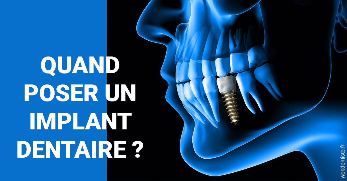https://www.scm-adn-chirurgiens-dentistes.fr/Les implants 1
