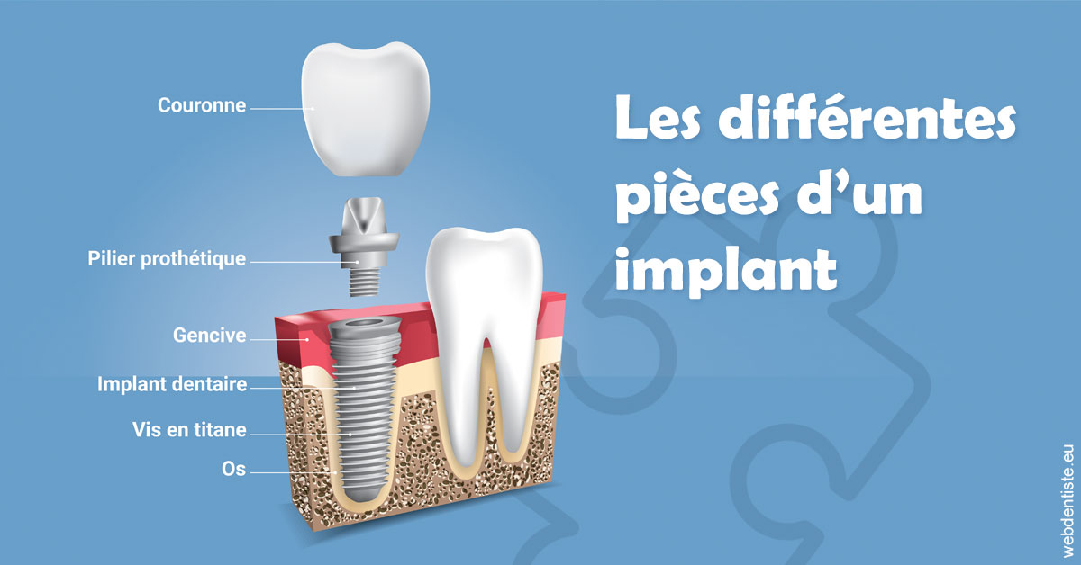 https://www.scm-adn-chirurgiens-dentistes.fr/Les différentes pièces d’un implant 1